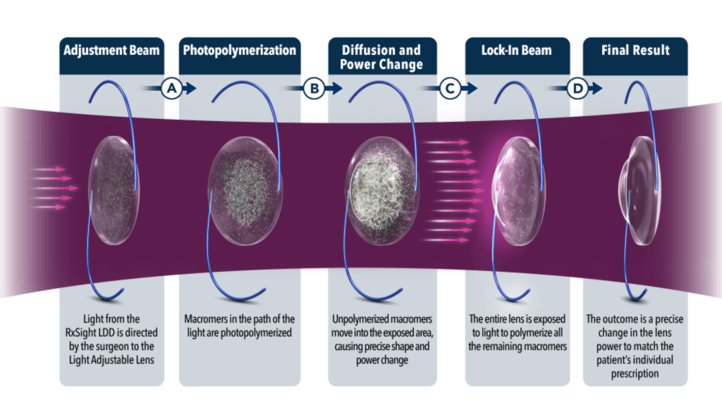 What is Light Adjustable Lens (LAL) Implants (1)