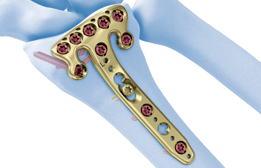 DePuy Synthes, Wright Medical Lead US Market for Orthopedic Small Bone and Joint Devices Due to Increased Foot & Ankle Procedures