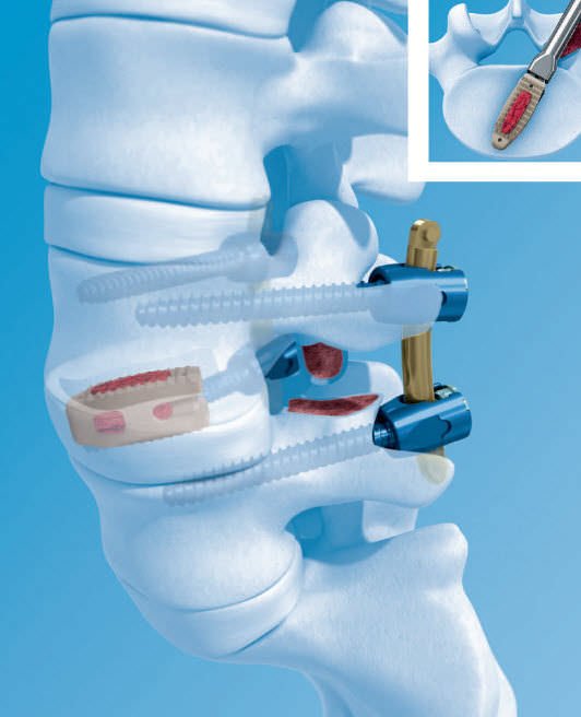 DePuy Synthes, Medtronic Leads Europe MIS Interbody Device Market Fueled by Increased Procedure Volumes and Product Innovation