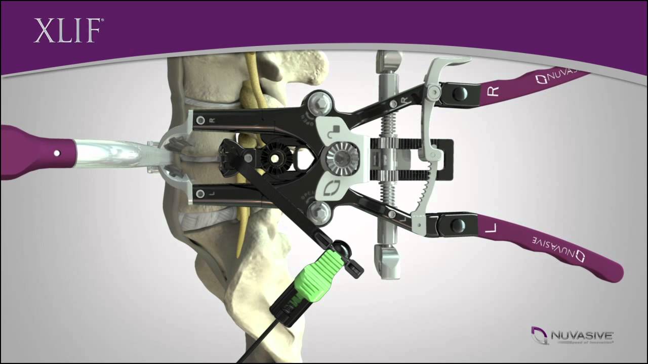 Zimmer Biomet Leads Brazil Minimally Invasive Spinal Implants Market Due to Brand Recognition and Third-Party Vendor Support