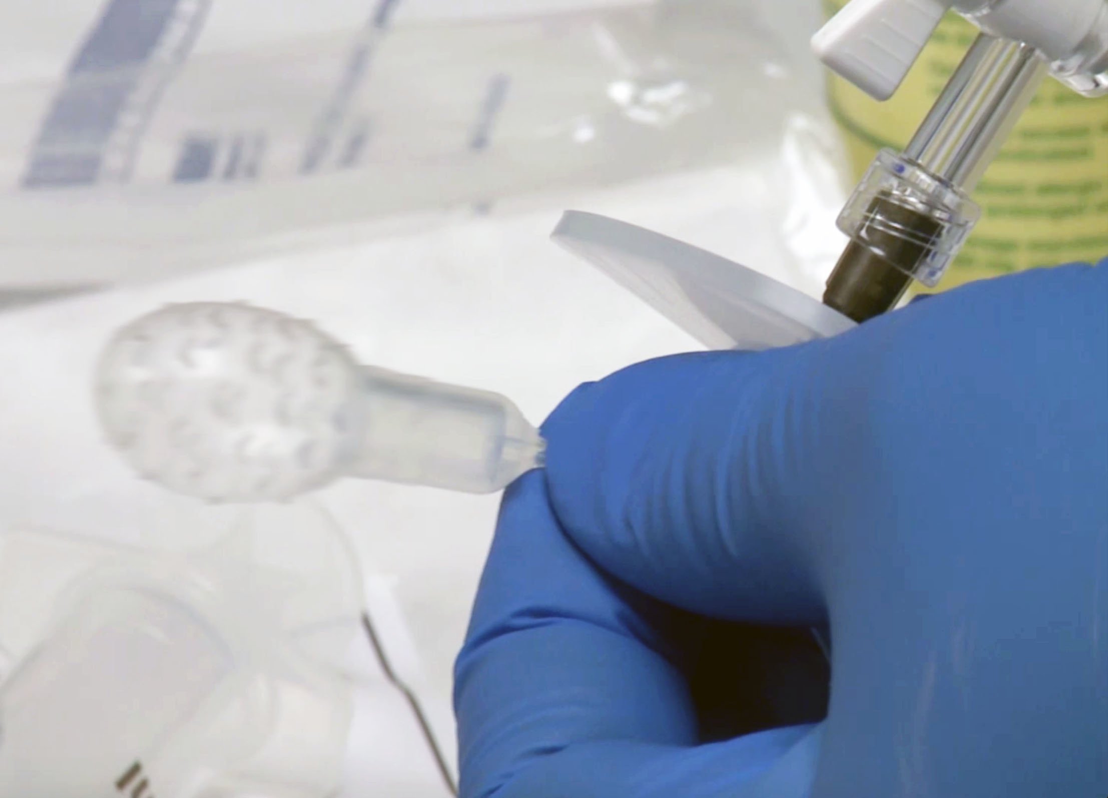 Swallowable Device Detects Pre-Cancerous Barrett's Esophagus