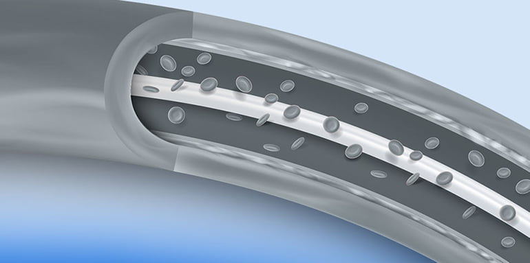 Access Vascular Receives FDA Clearance For Its HydroPICC Catheter