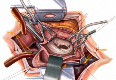 Minimally Invasive Surgery for Mitral Valve Disease to be Tested in Trial
