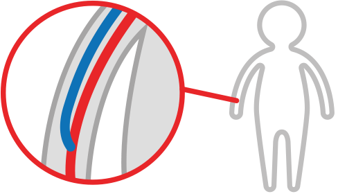 Proteon Therapeutics Completes Enrollment in PATENCY-2, Phase 3 Clinical Trial of Investigational Vonapanitase