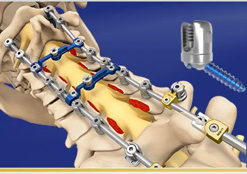Spine Wave Launches Proficient® Posterior Cervical Spine System Implants
