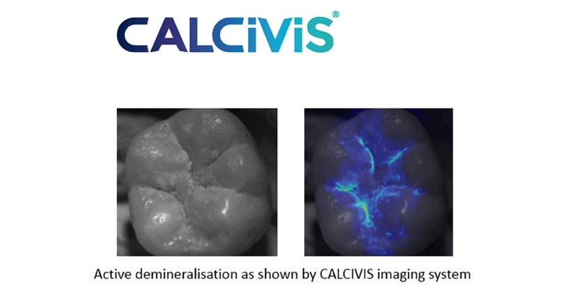 CALCIVIS Launches its Unique CALCIVIS Imaging System in the United Kingdom
