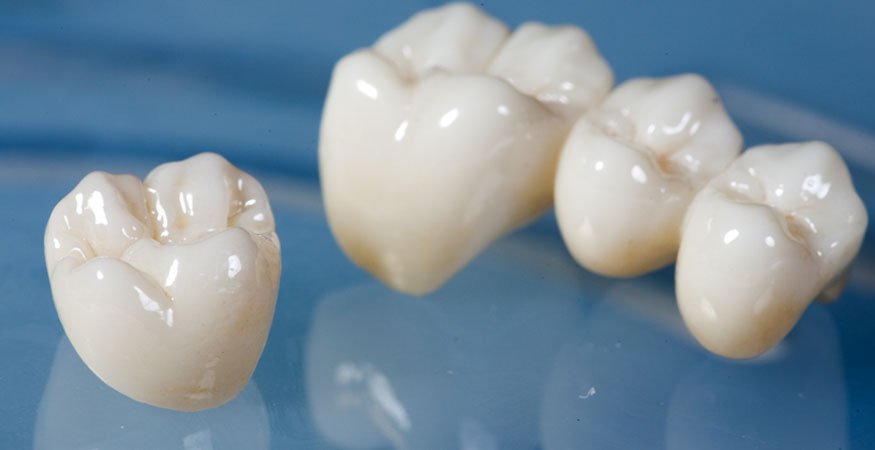 Glidewell Dental Releases BruxZir® Esthetic Solid Zirconia