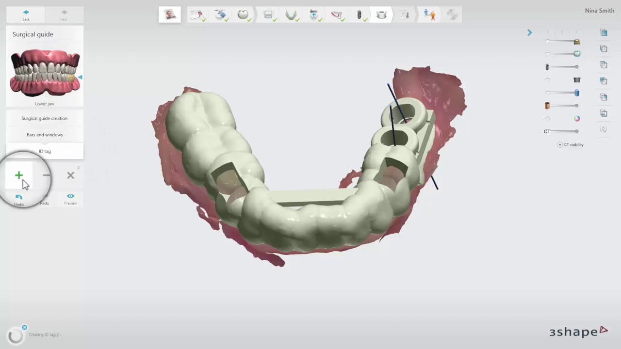 SprintRay 3D Printers Now Supported in 3Shape Implant Studio for Surgical Guide Production
