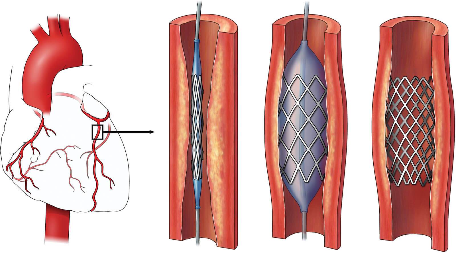 Over 2 Million Stents Implanted per Year in the U.S.