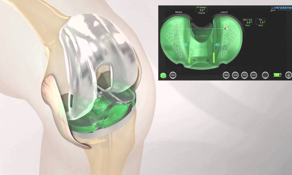 OrthoSensor, Inc. Secures Additional 510(K) Clearance