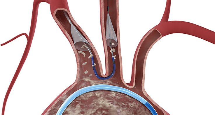 Boston Scientific Announces Agreement to Acquire Claret Medical, Inc.