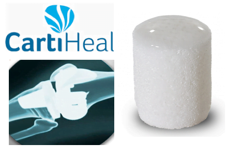 CartiHeal's Agili-C™ Implant Promotes the Regenerative Capacity of Articular Cartilage Defects in Human Cadaveric Ex-vivo Model