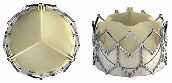 Edwards Lifesciences and Medtronic Lead the U.S. TAVR Market, Despite Threat of New Competition – New Analysis from iData Research
