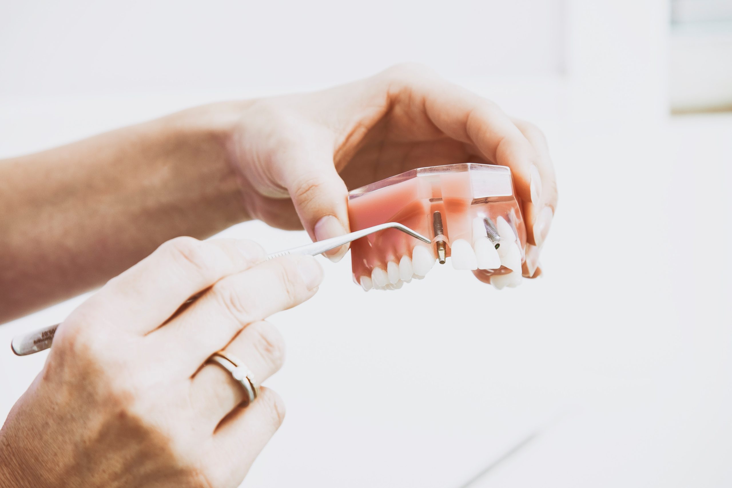 US Dental Implant Statistics Show a Shift to Value & Discount Implants