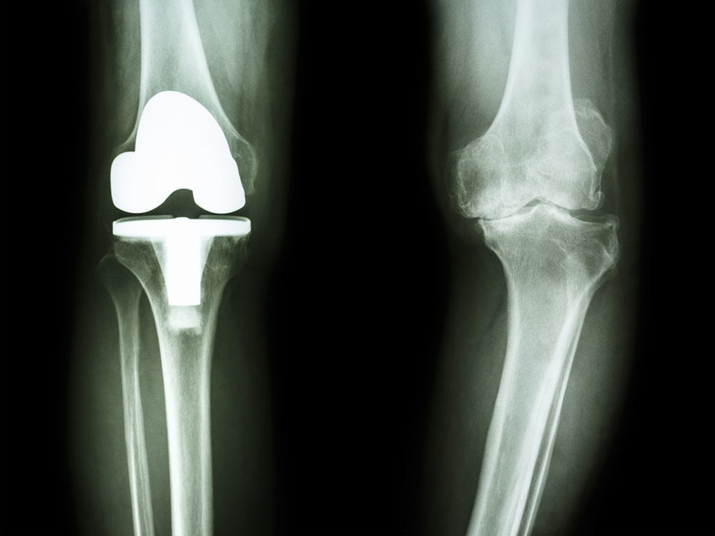 New Knee Replacement Technology 2018