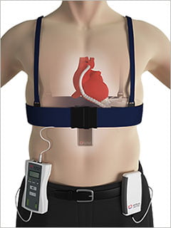 Wireless Ventricular Assist Device Announced by Leviticus Cardio and Jarvik Heart