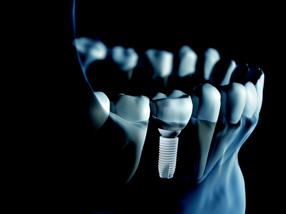 Straumann Partners with Z-Systems for Ceramic Implant Distribution