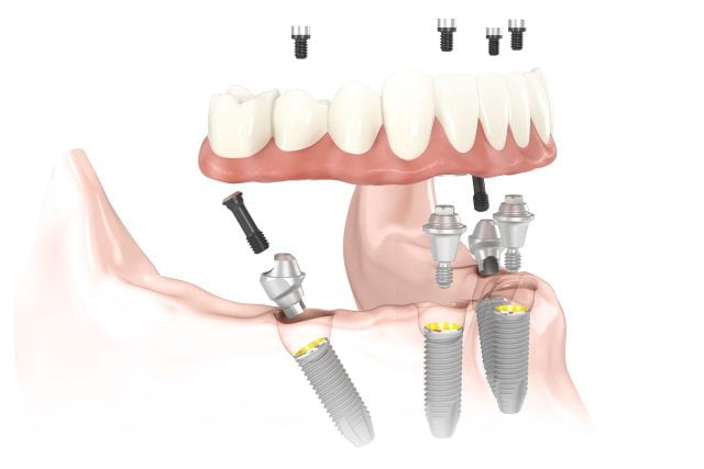 U.S. Dental Implant and Final Abutment Market to Reach $1.5 Billion by 2025 - New Study by iData Research