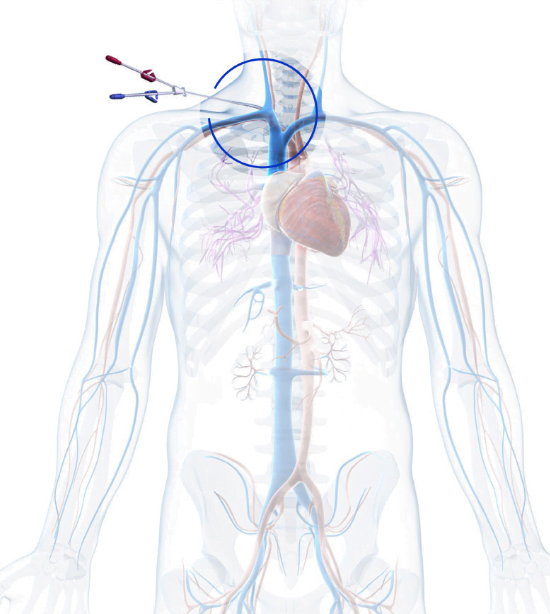 SAVE-US Pivotal Trial Receives Positive Clinical Results