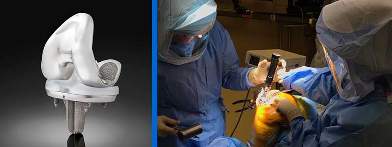 Exactech Launches Truliant Porous Knee Implants