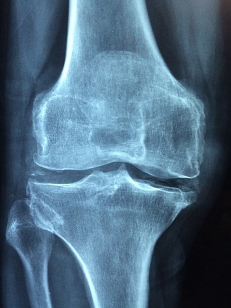 Persona Knee Revision System Launched by Zimmer Biomet (ZBH)
