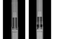 NuVasive Recalls Scoliosis Treatment Devices