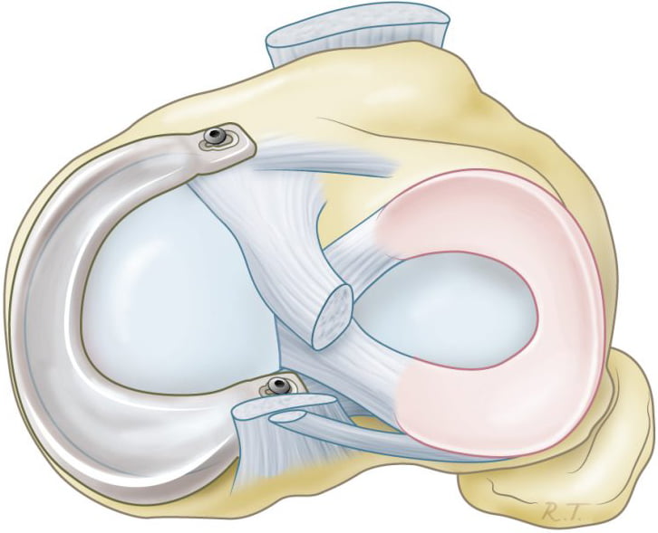 Interview with ATRO Medical CEO on Trammpolin® Meniscus Prosthesis