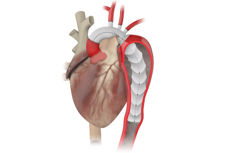 Terumo Aortic Gains FDA Breakthrough Status for Aortic Repair Device