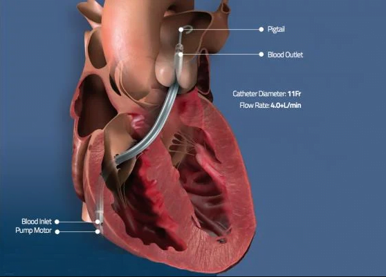 FDA Grants Emergency Use Authorization to Abiomed for Impella RP