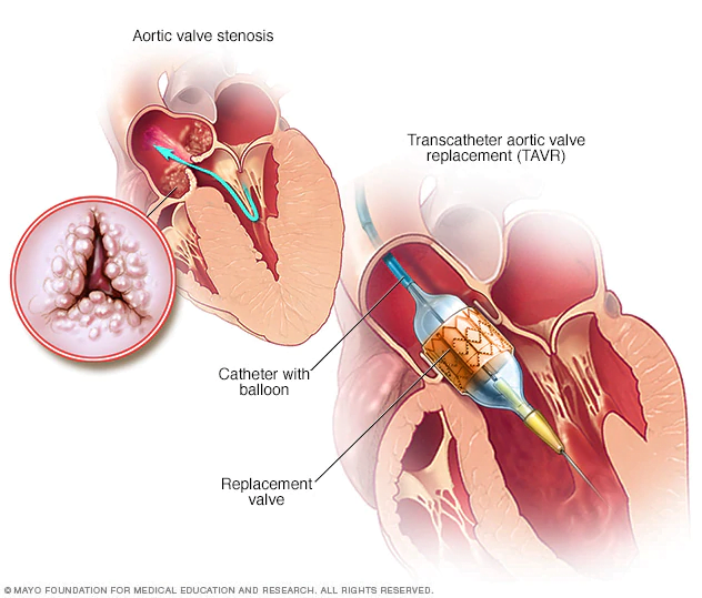 FDA Approval of TAVR in Low-Risk Patients Set to Drive Market Growth