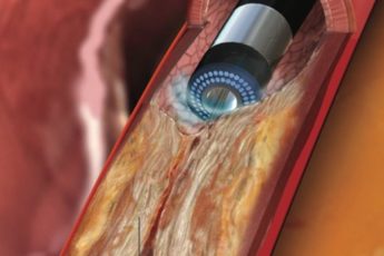 Over 190,000 Atherectomy Procedures Performed Every Year In The United States