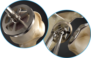 Catalyst OrthoScience Inc., a medical device company focused on the upper extremity orthopedics market, has received clearance from the U.S. Food & Drug Administration (FDA) to market its reverse shoulder system.