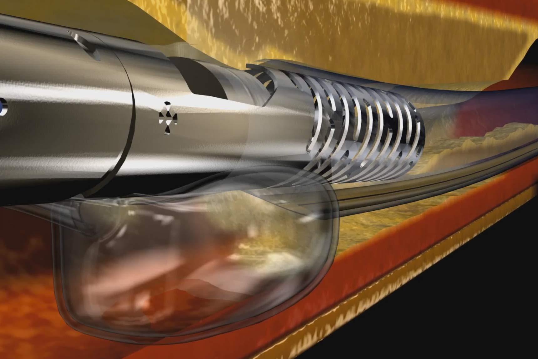 Avinger Receives New Patent Covering Pantheris Image-Guided Atherectomy System