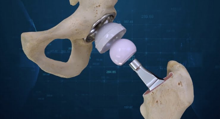 Conformis Announces the First 3D Total Hip Replacement Surgeries Performed at JFK Medical Center in Florida