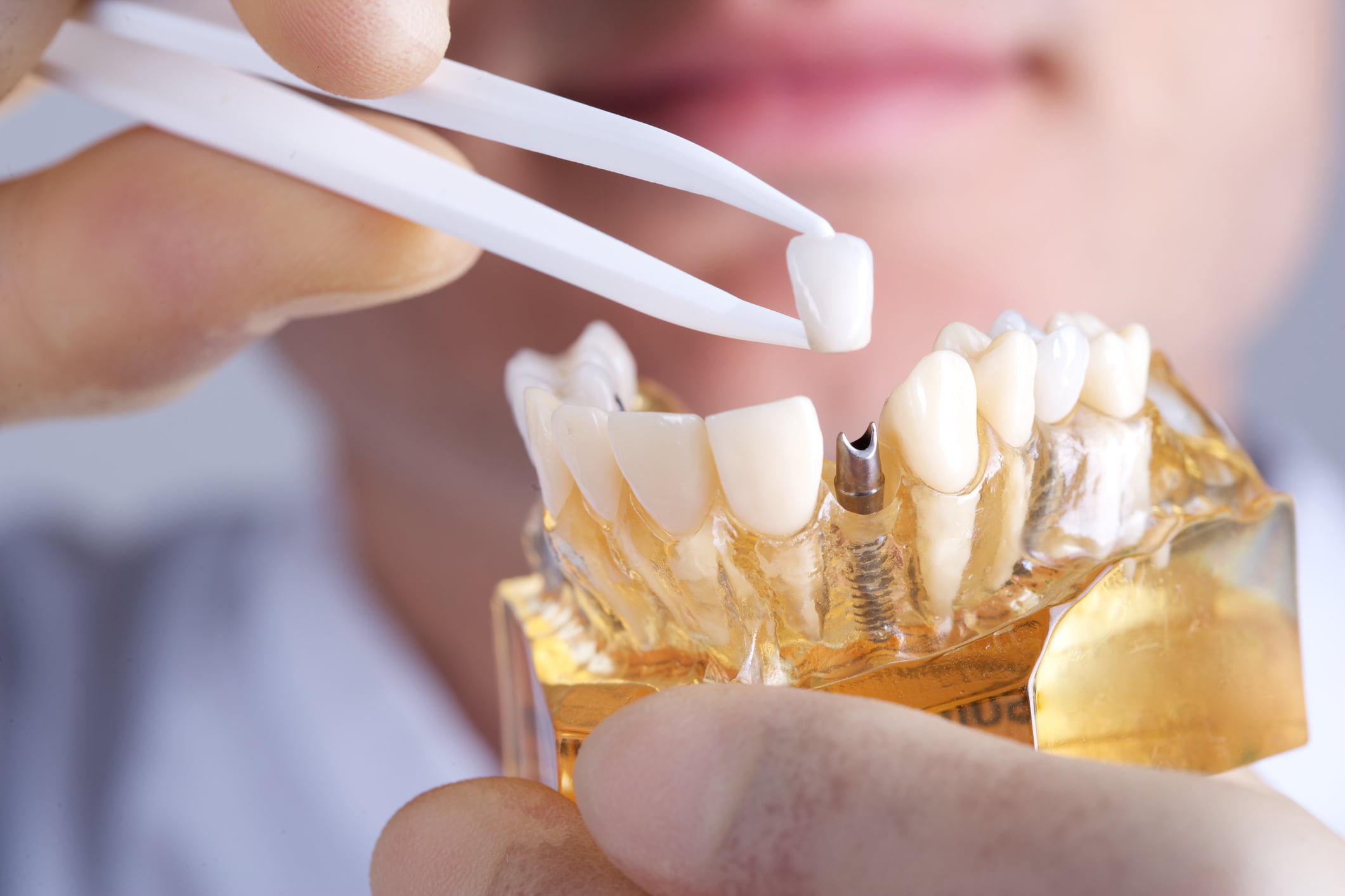 Dental Prosthetics Market in Australia to Pass $500 Million by 2024