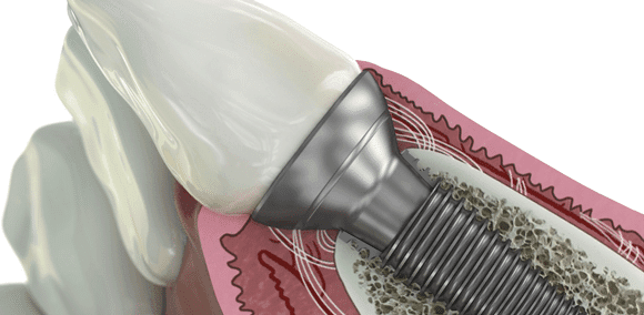 Henry Schein Strengthens And Expands Its Global Dental Implant Business With Three Investments
