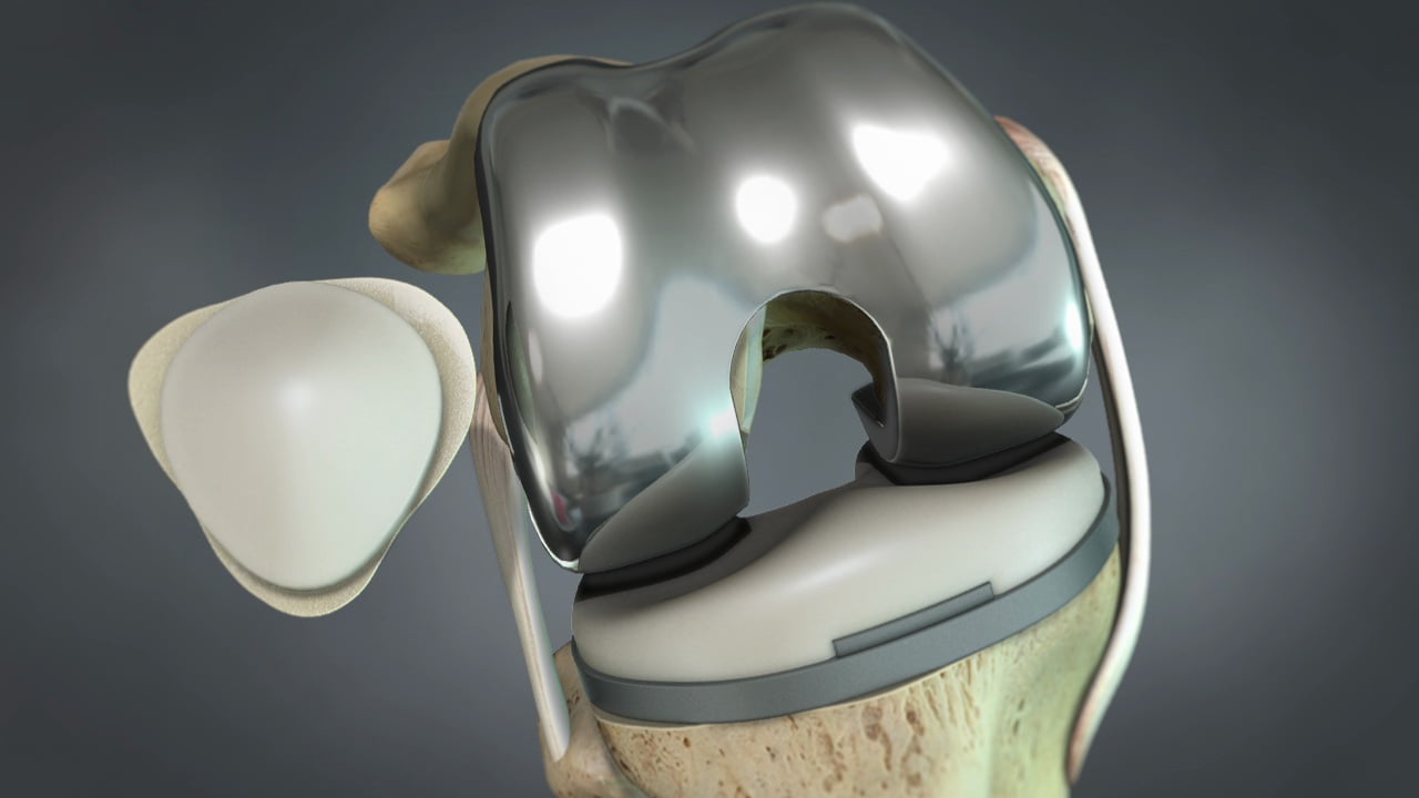 U.S. Orthopedic Large Joint Market to Reach $8.6 Billion by 2024