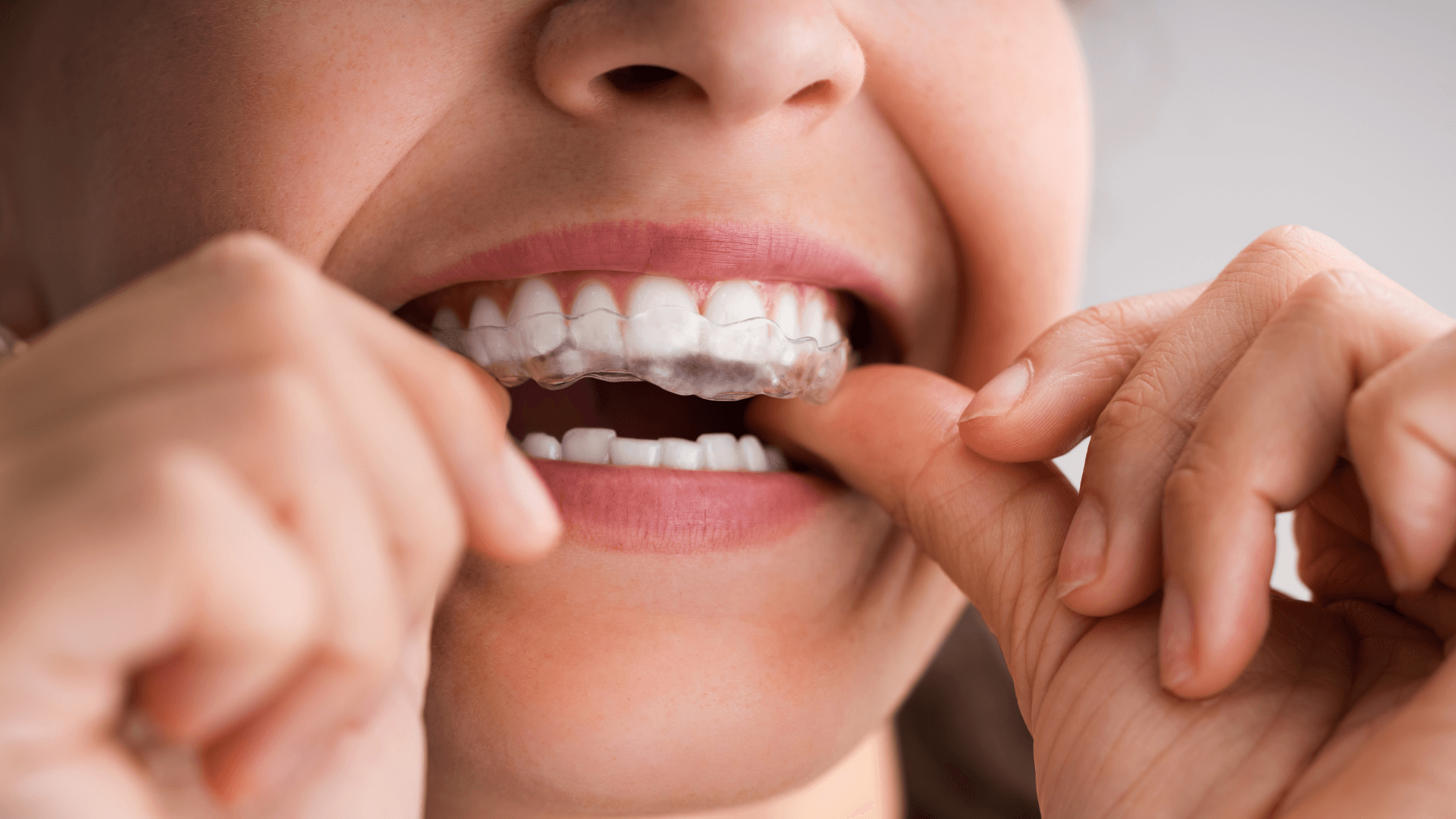 The 3 Dominating Competitors Transforming the Clear Aligners Market