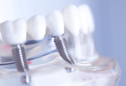 Top 3 Market Share Leaders in the Latin American Dental Implant Market
