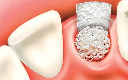 What Will the European Dental Bone Graft Substitute Market Look Like in 7 Years?