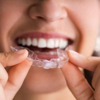Are Clear Aligners More Popular Than Braces?