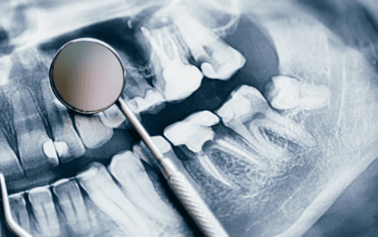 A Closer Look at the Top Innovators in the U.S. Dental Bone Graft Market