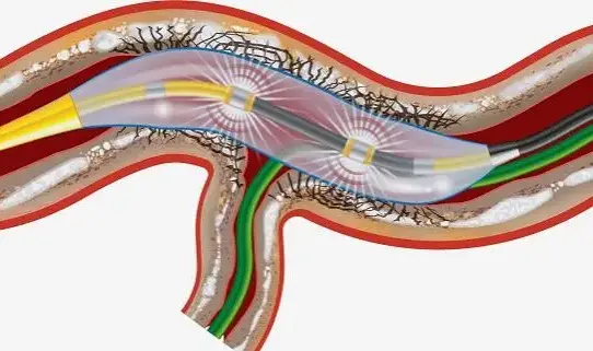 The Dynamic Landscape of the Intravascular Lithotripsy (IVL) Market