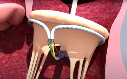 InnovHeart's Groundbreaking TMVr Procedure Achieves Remarkable Success: SATURN Valve