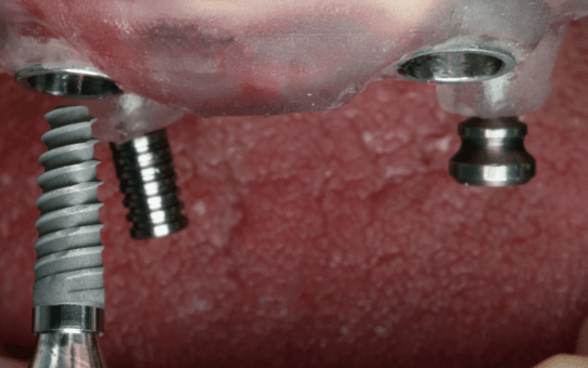 Key Drivers Shaping the Global Dental Bone Graft Substitute Market