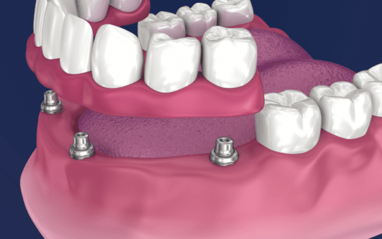 How Dental Overdentures are Revolutionizing Oral Care for Seniors