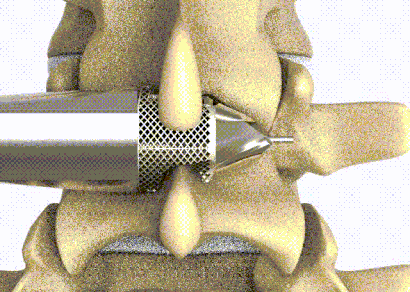 3D Printing and Smart Biomaterials in Spine Surgery
