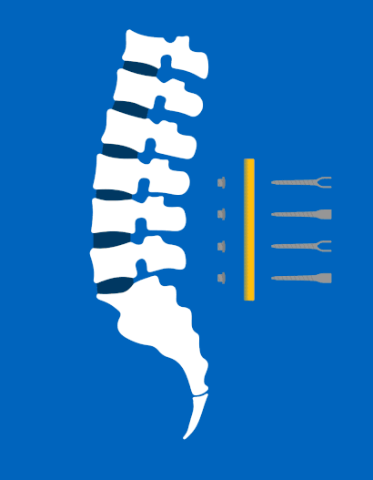 what are spinal implants