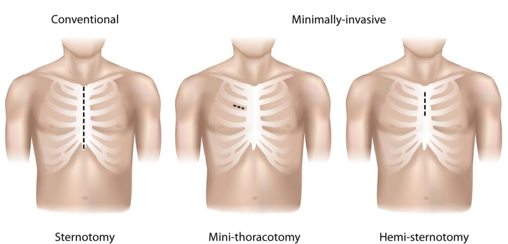 Minimally Invasive Cardiac Surgery A New Era