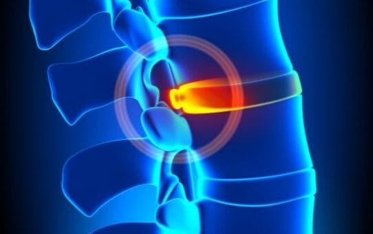 Minimally Invasive Spine Surgery (MISS): The Future of Spinal Procedures?